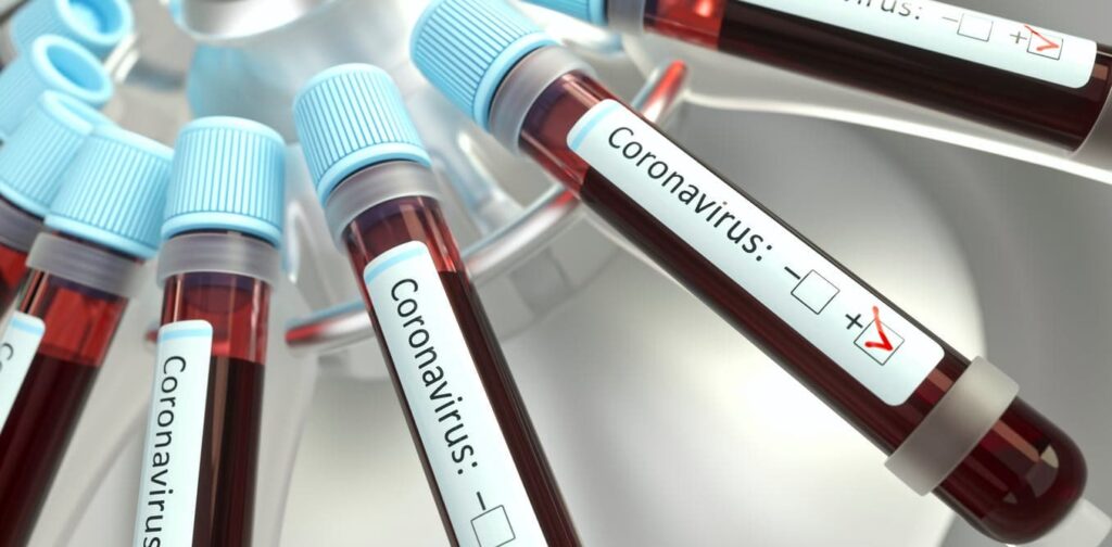 Η Covid-19 επιτίθεται άμεσα στο πάγκρεας και προκαλεί την εμφάνιση διαβήτη